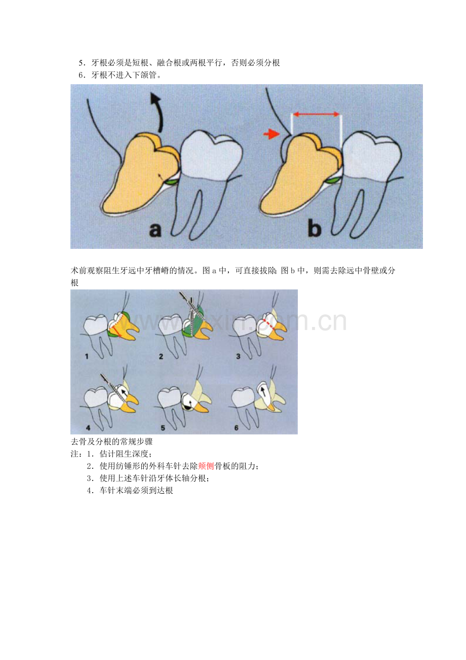 阻生牙拔出.doc_第3页