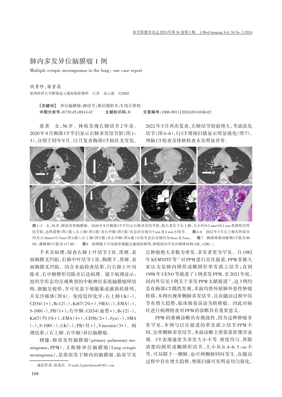 肺内多发异位脑膜瘤1例.pdf_第1页