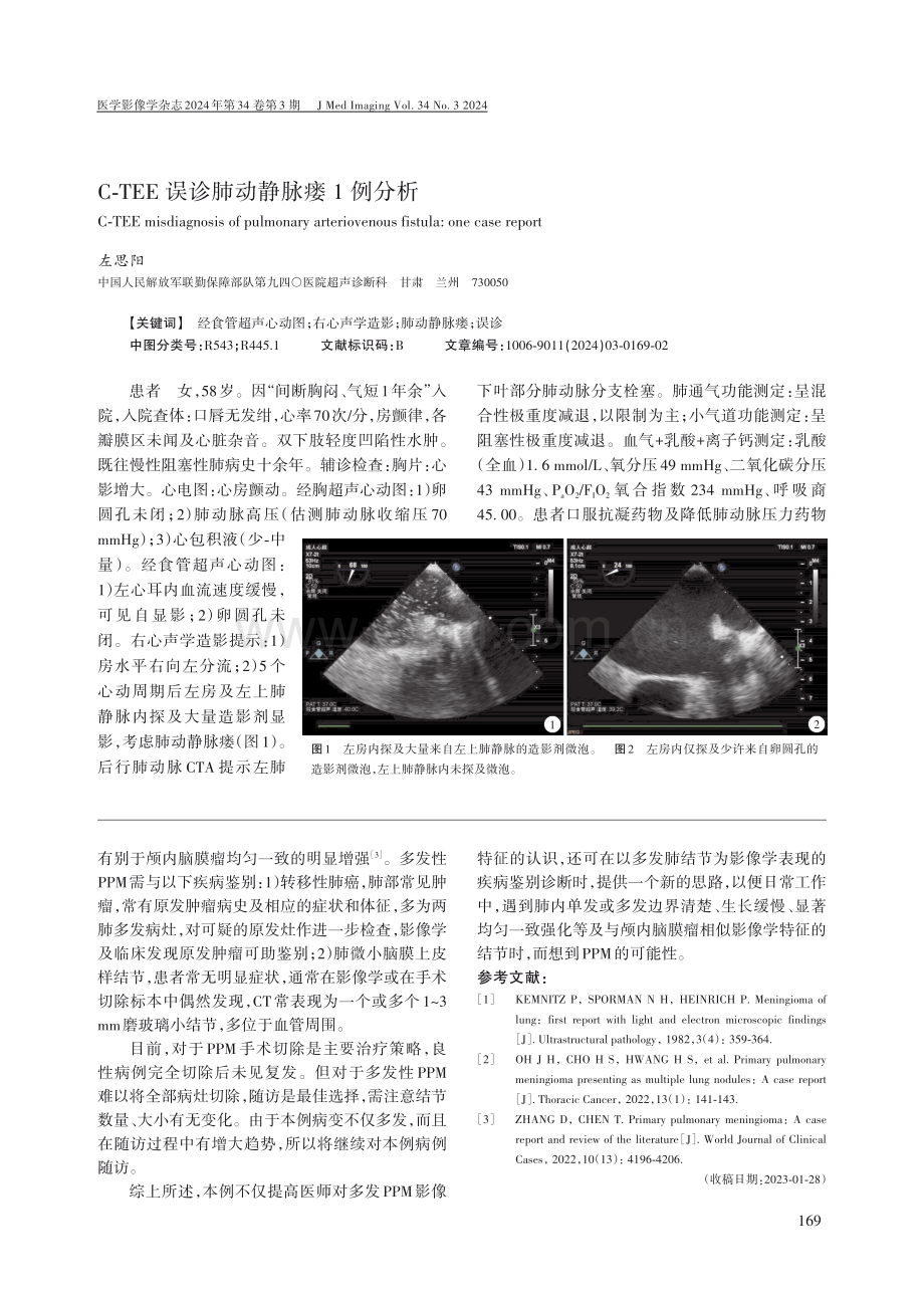 肺内多发异位脑膜瘤1例.pdf_第2页