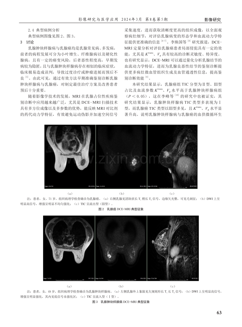 动态增强磁共振成像在乳腺肿块样腺病与乳腺癌鉴别诊断中的应用价值分析.pdf_第3页