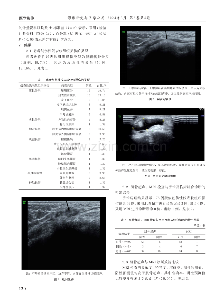 肌骨超声、MRI诊断创伤性浅表软组织损伤的价值分析.pdf_第2页