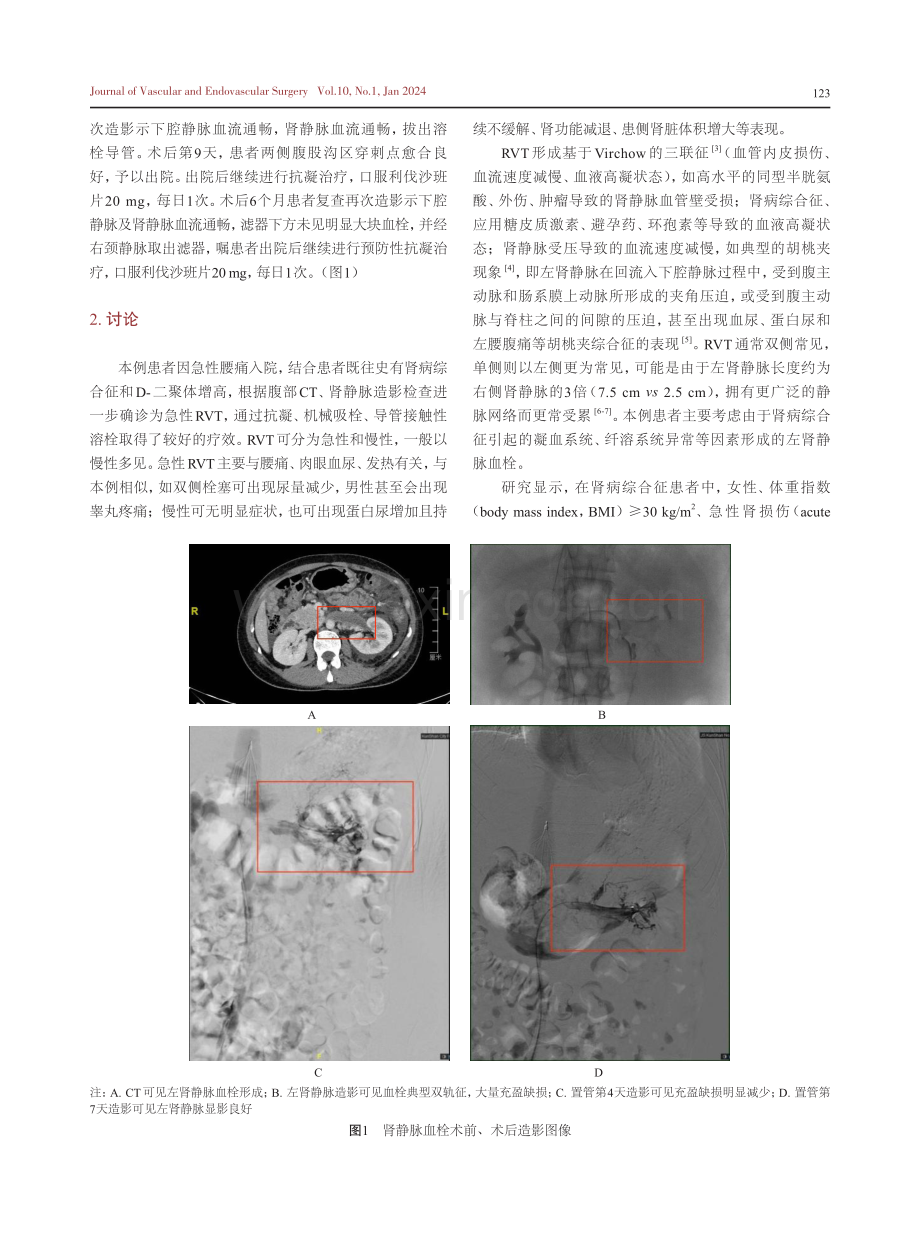 机械吸栓联合导管接触性溶栓治疗肾静脉血栓形成1例.pdf_第2页