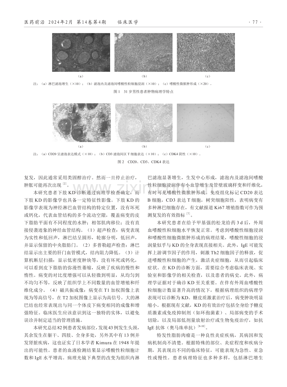 临床误诊为脂肪肉瘤的腹股沟木村病1例报告.pdf_第2页