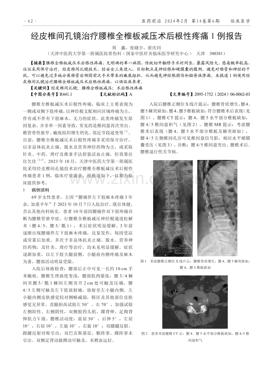 经皮椎间孔镜治疗腰椎全椎板减压术后根性疼痛1例报告.pdf_第1页