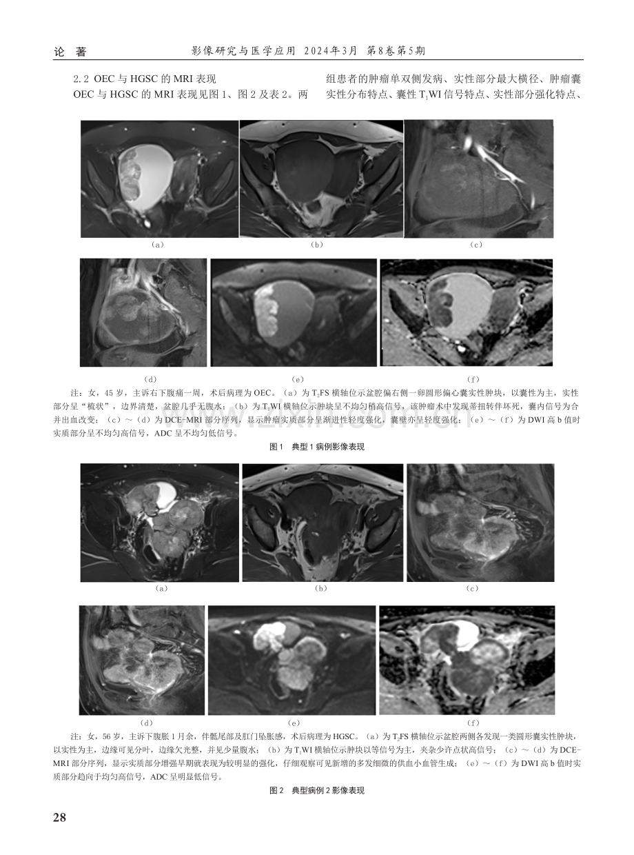 卵巢子宫内膜样癌与高级别浆液性癌的MRI鉴别诊断.pdf_第3页