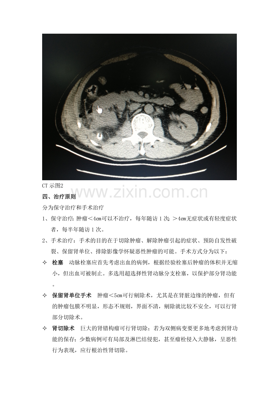 肾错构瘤的简介及围手术期护理.doc_第3页