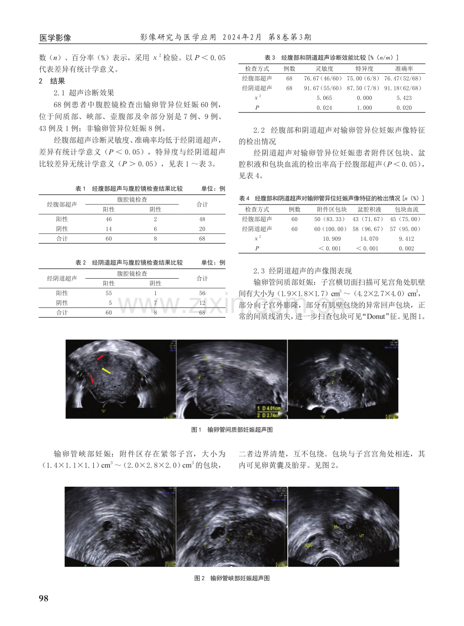 经阴道超声对输卵管异位妊娠的早期诊断价值.pdf_第2页