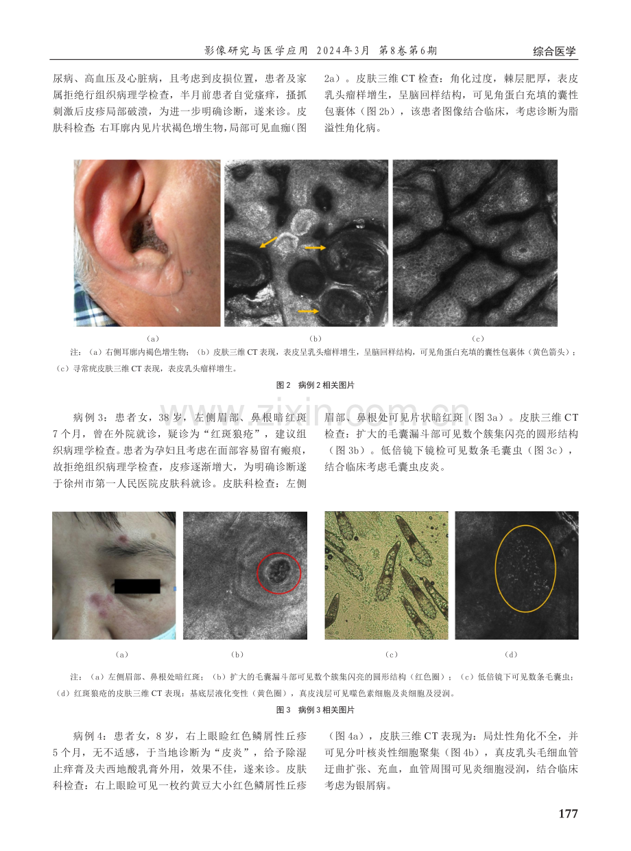 皮肤三维CT在特殊部位及特殊人群的非典型皮肤病中的应用价值.pdf_第2页