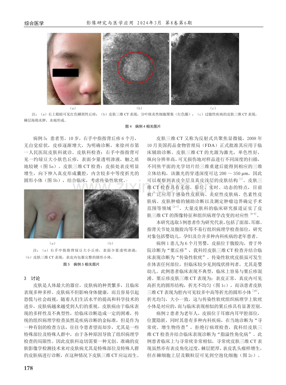 皮肤三维CT在特殊部位及特殊人群的非典型皮肤病中的应用价值.pdf_第3页