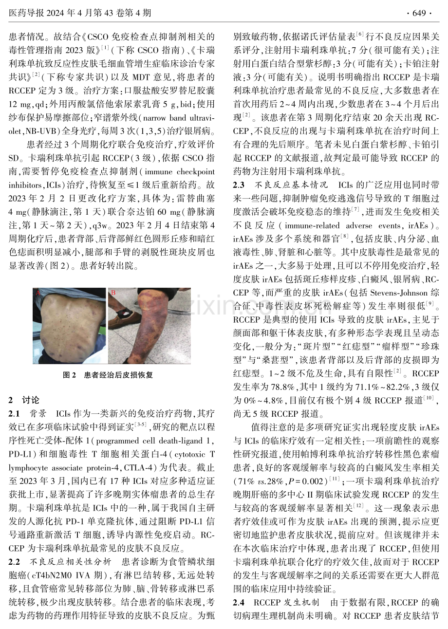 卡瑞利珠单抗致反应性皮肤毛细血管增生症1例.pdf_第2页