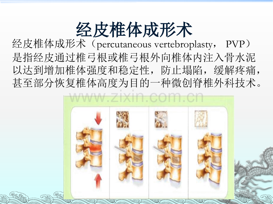 胸腰椎骨折的微创手术治疗课件.ppt_第3页