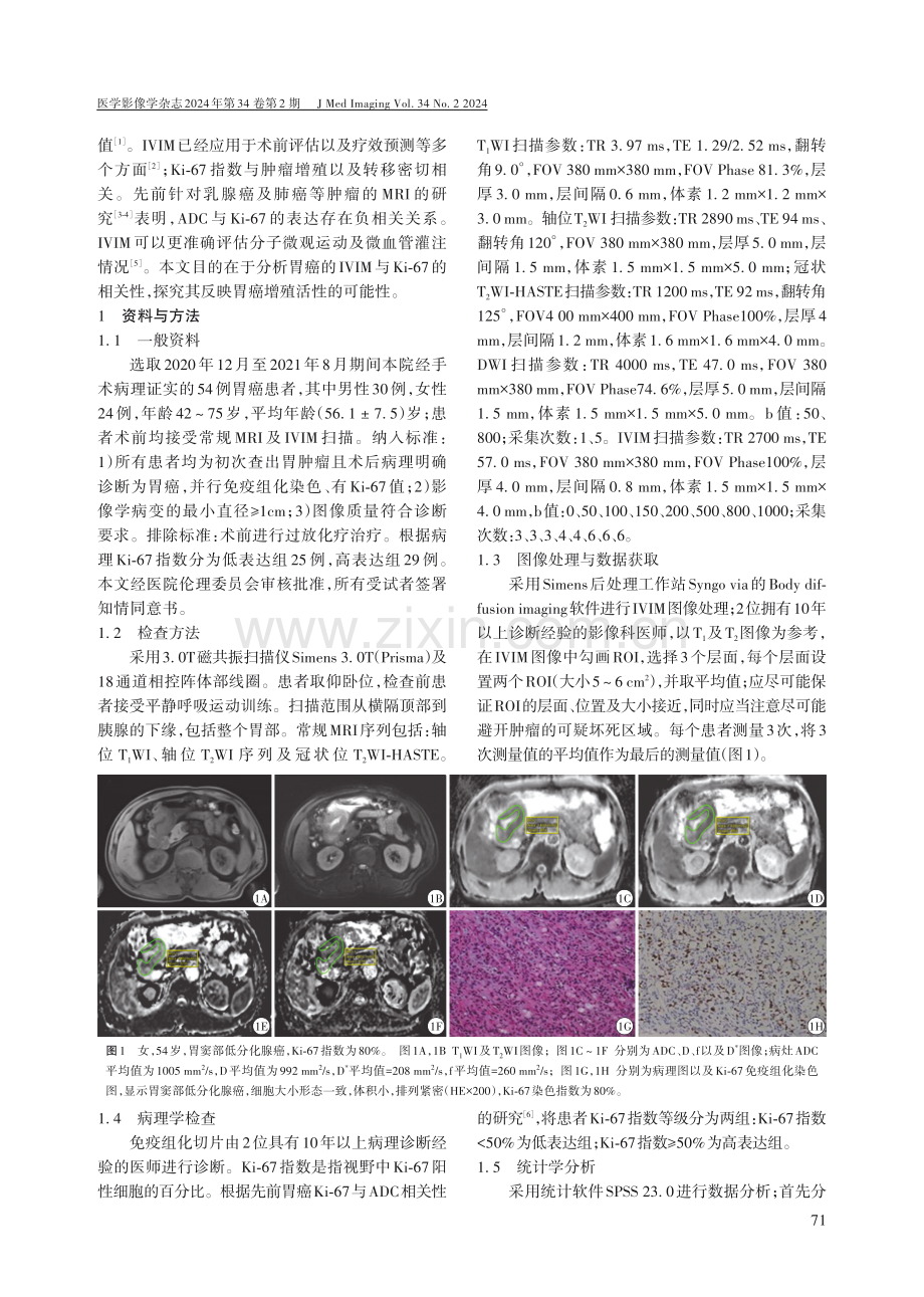 体素内不相干运动对不同Ki-67指数胃癌的诊断价值.pdf_第2页