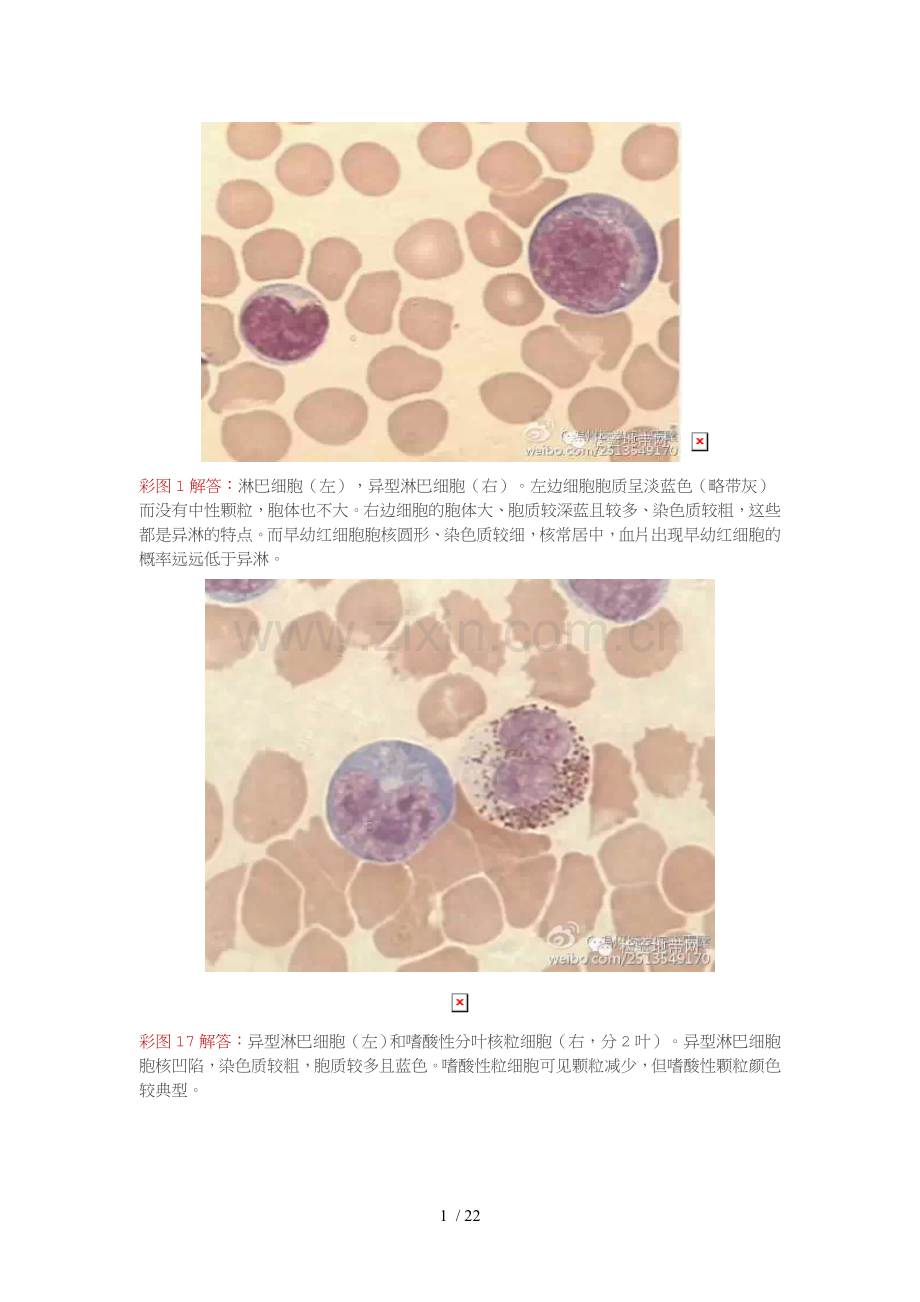 异型淋巴细胞的鉴定与区别.doc_第1页