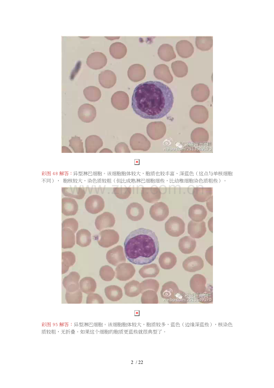 异型淋巴细胞的鉴定与区别.doc_第2页