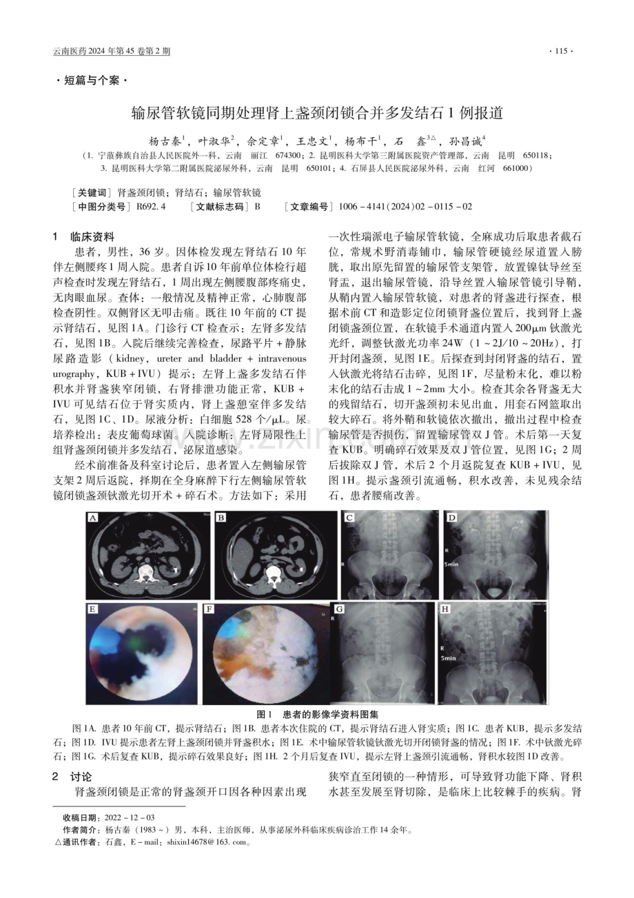 输尿管软镜同期处理肾上盏颈闭锁合并多发结石1例报道.pdf_第1页