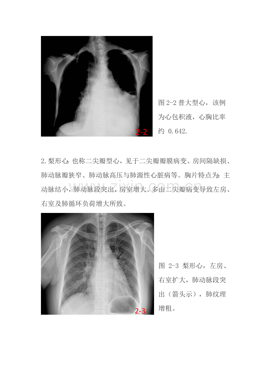 常见的X线胸片.doc_第3页