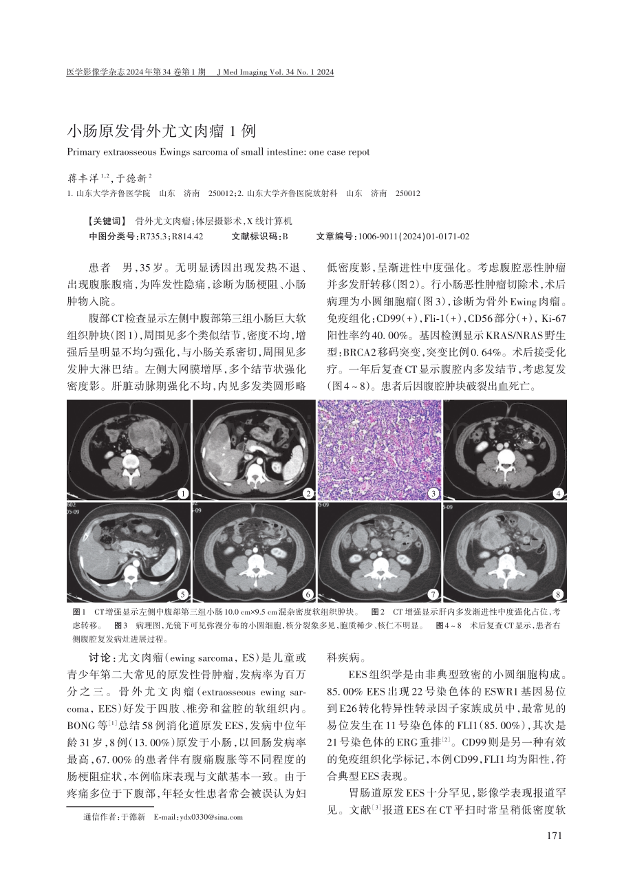 小肠原发骨外尤文肉瘤1例.pdf_第1页