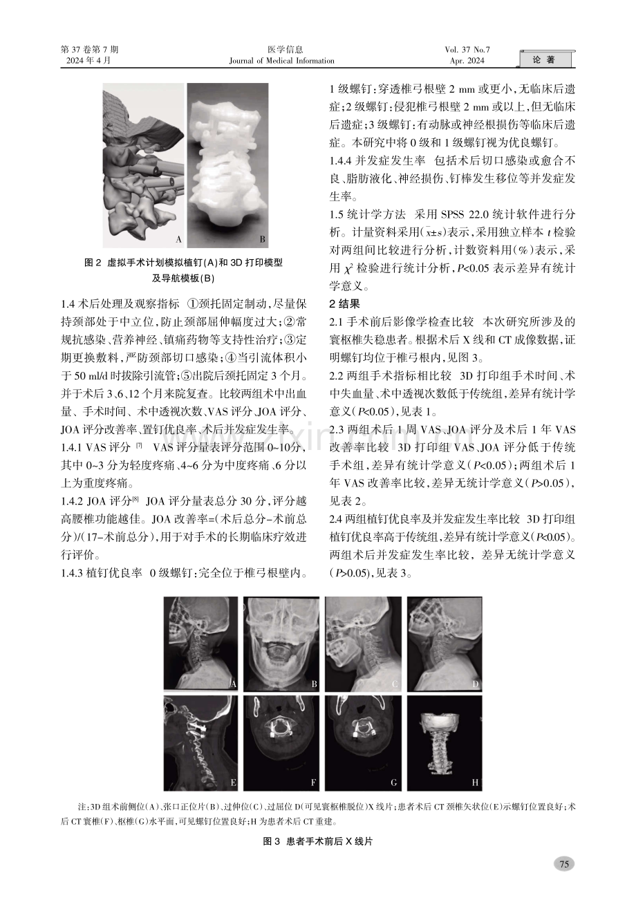 虚拟手术计划和3D打印导板辅助寰椎侧块结合枢椎椎弓根螺钉治疗寰枢椎失稳的疗效与安全性.pdf_第3页