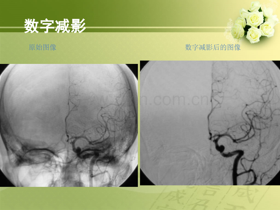 如何阅读脑血管DSA片幻灯片.ppt_第3页