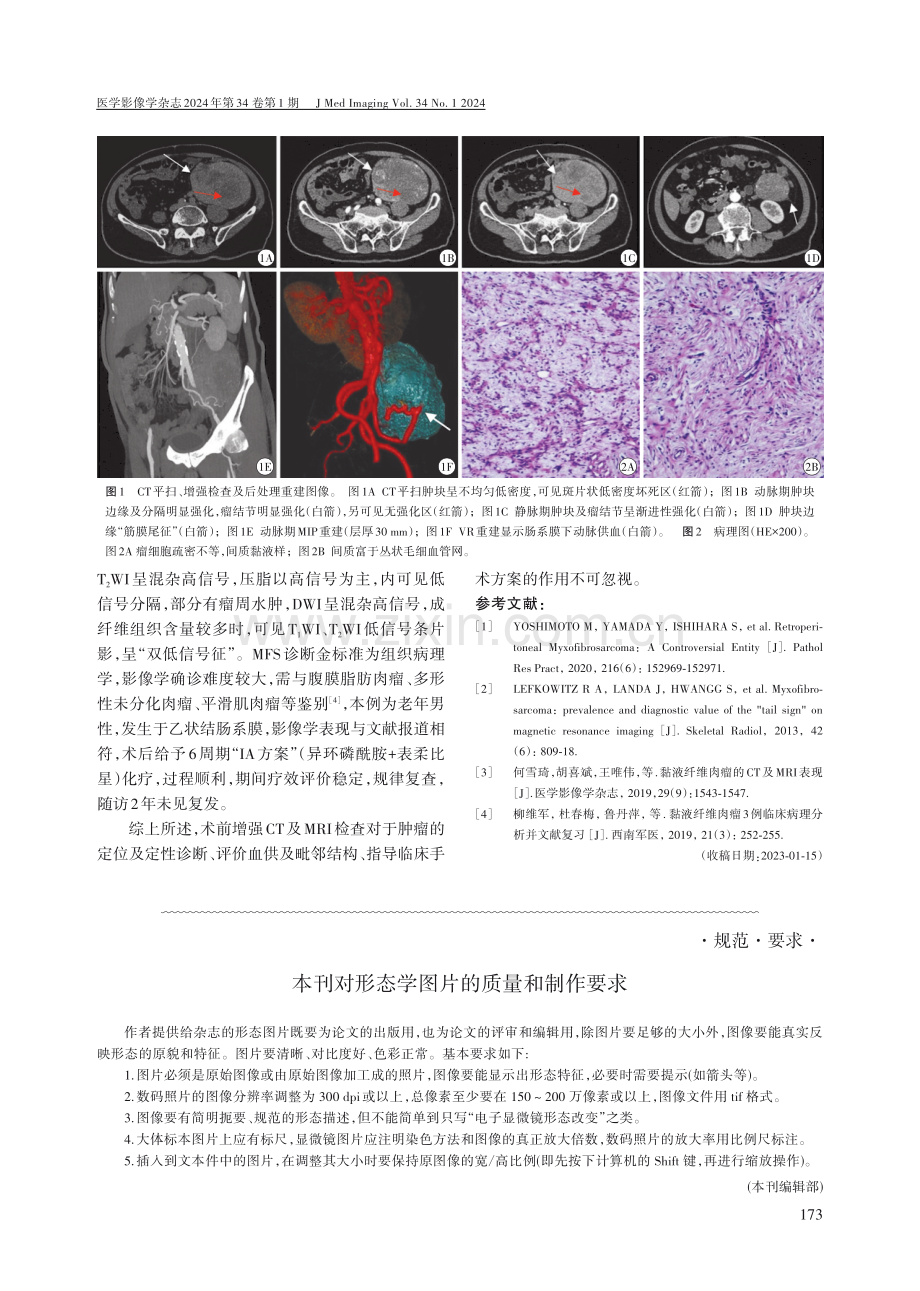 乙状结肠系膜黏液纤维肉瘤1例.pdf_第2页