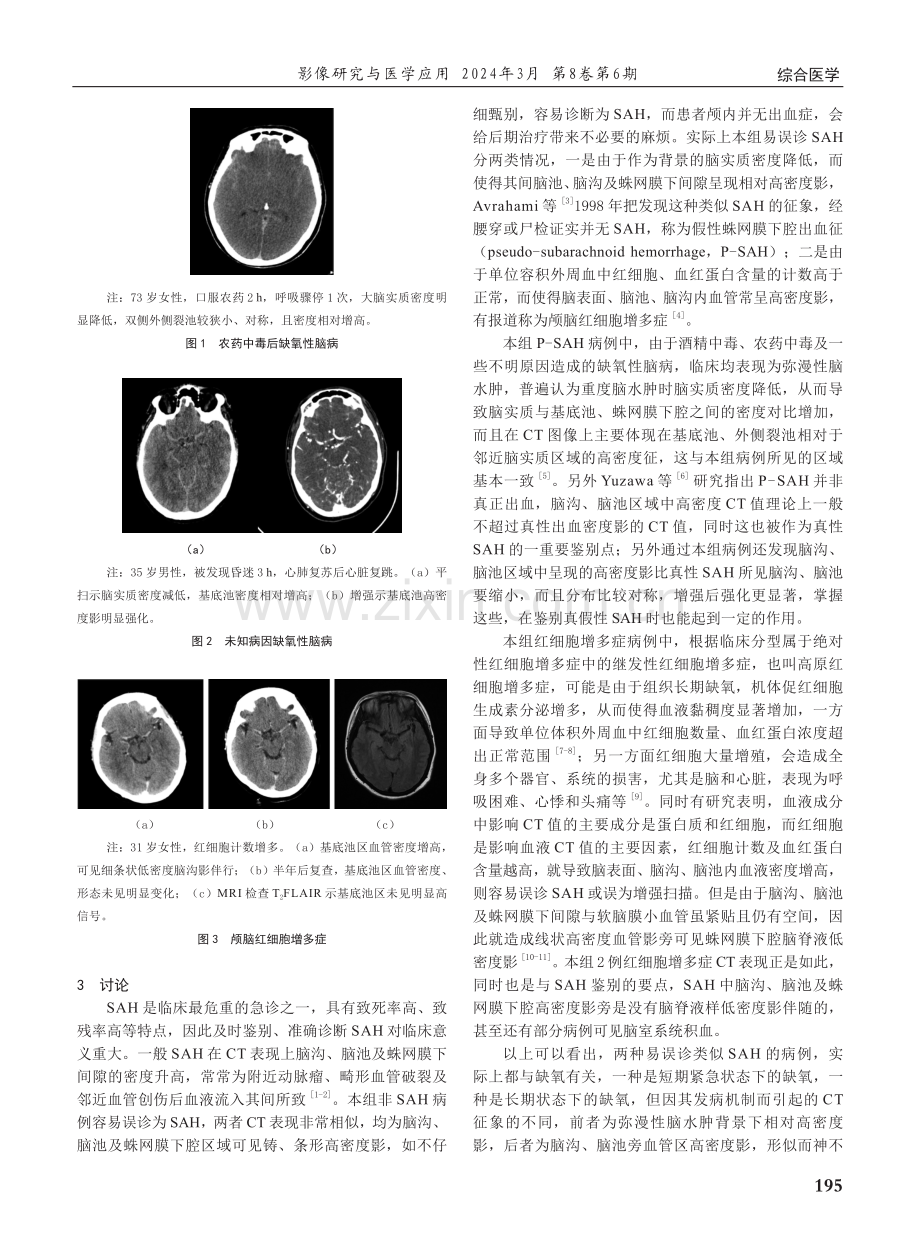 易误诊为蛛网膜下腔出血的CT征象分析.pdf_第2页