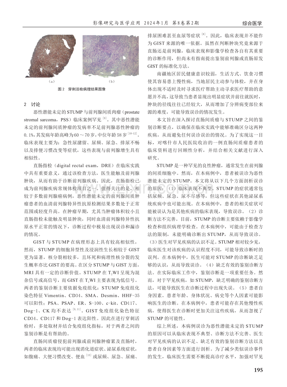 直肠间质瘤误诊为前列腺间质肿瘤1例报告并文献复习.pdf_第2页