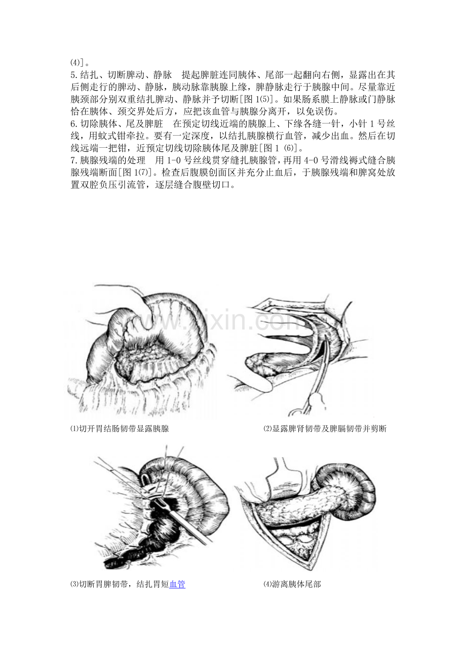 胰腺体尾部切除术.doc_第2页