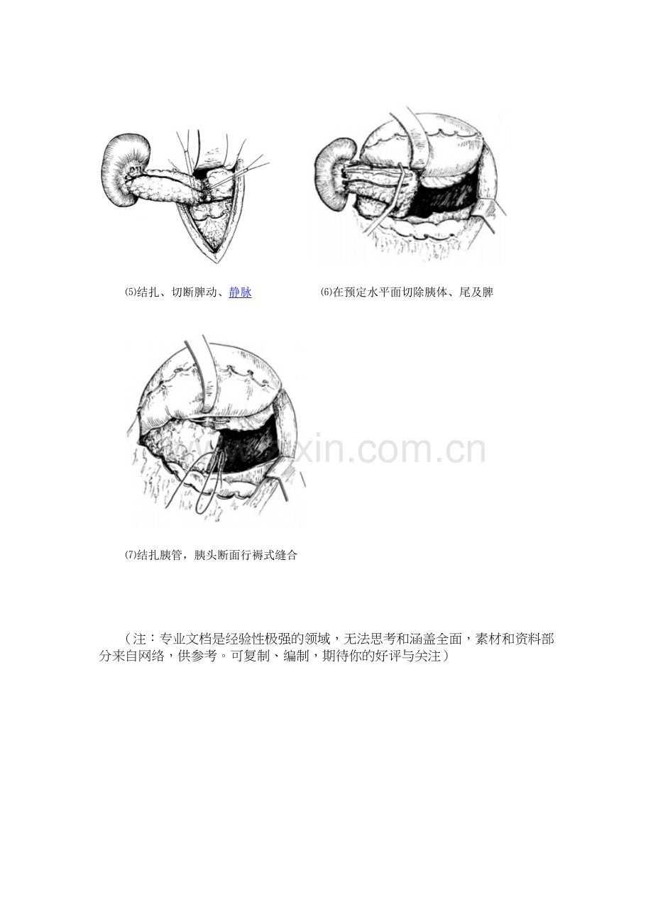 胰腺体尾部切除术.doc_第3页