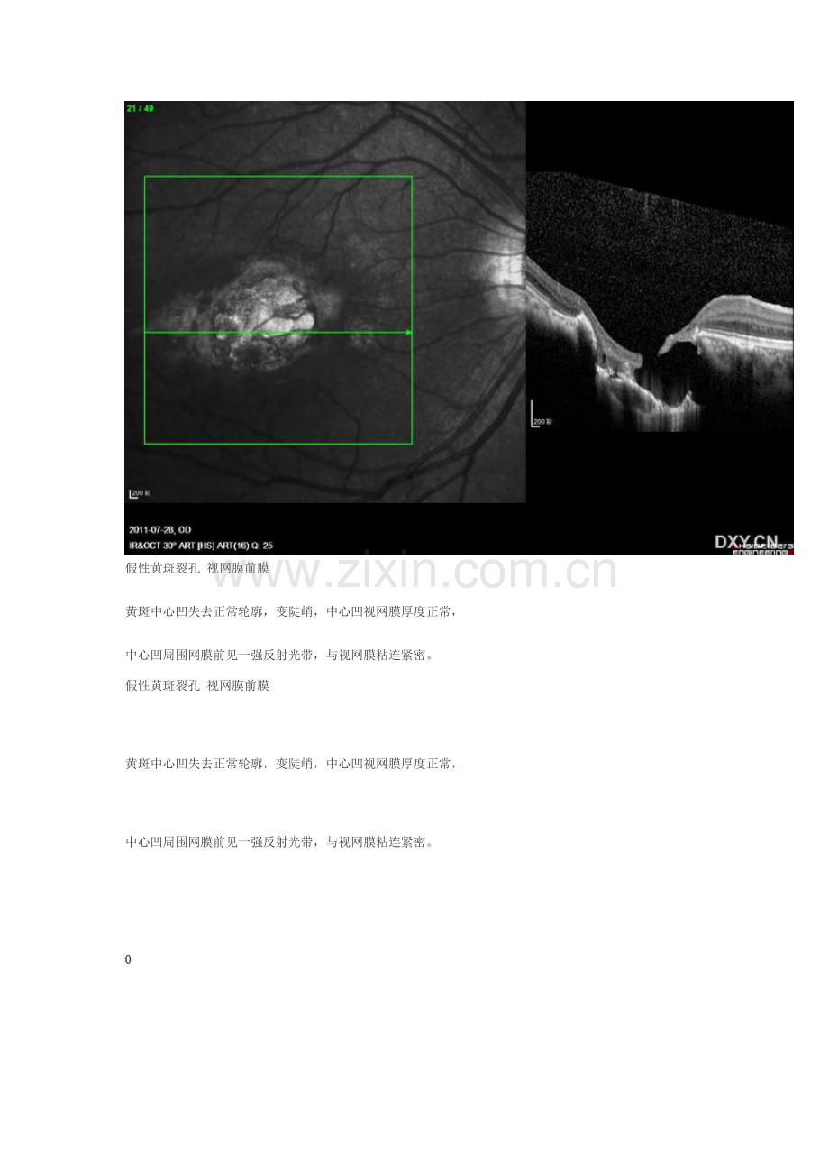 OCT视网膜10层结构.doc_第3页