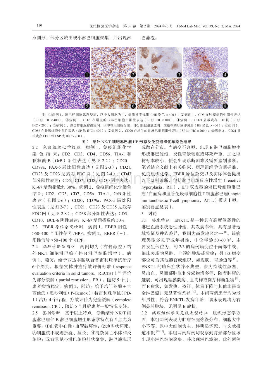 结外NK_T细胞淋巴瘤伴B淋巴细胞增生2例的临床病理学研究.pdf_第3页