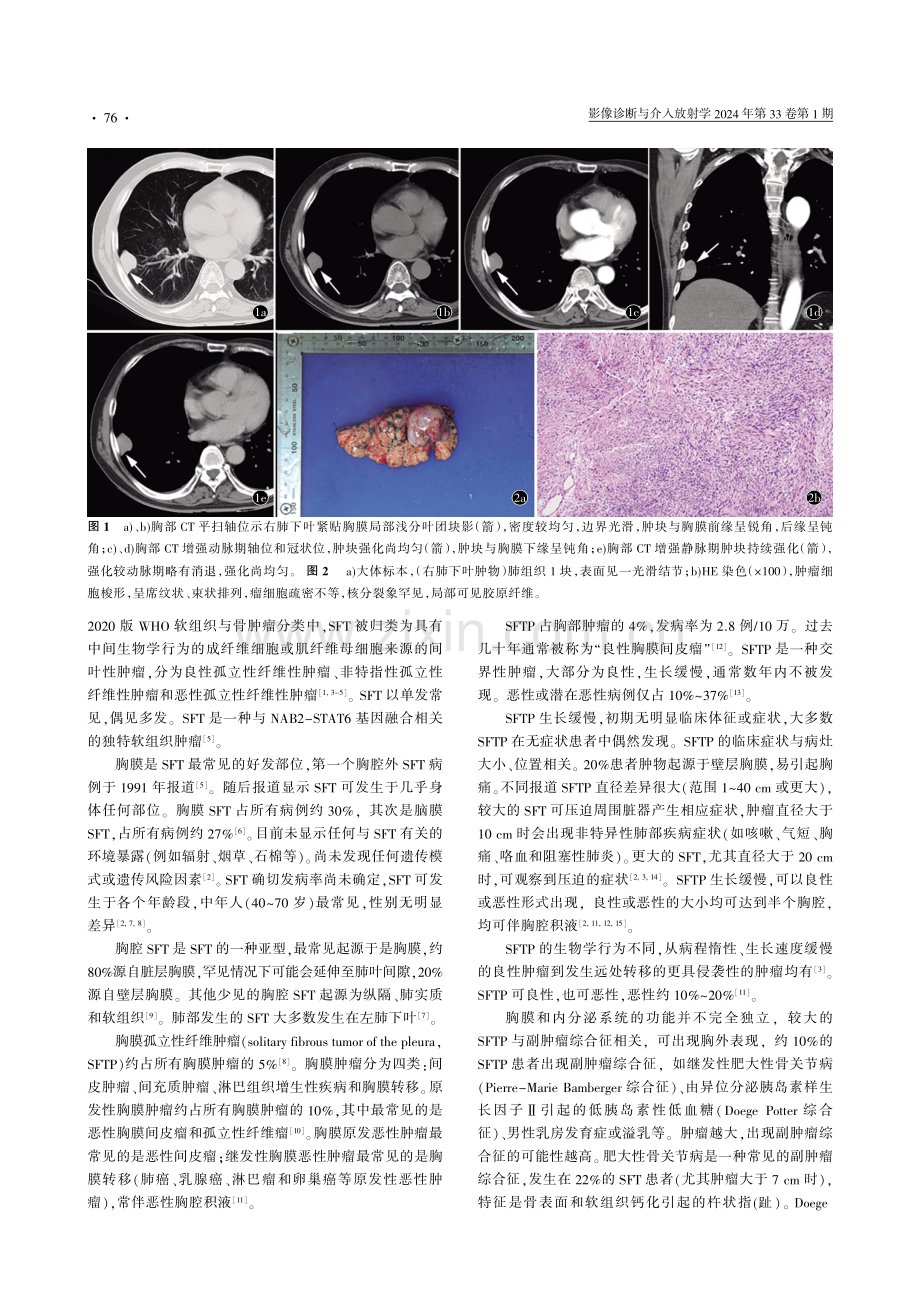 孤立性胸膜肿瘤的影像诊断思维.pdf_第2页