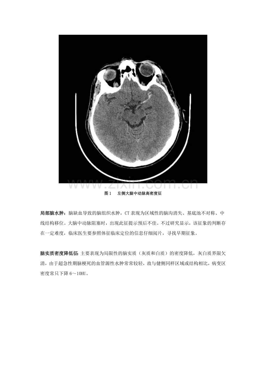 看图说话：缺血性脑卒中超急性期的影像学特点.doc_第2页