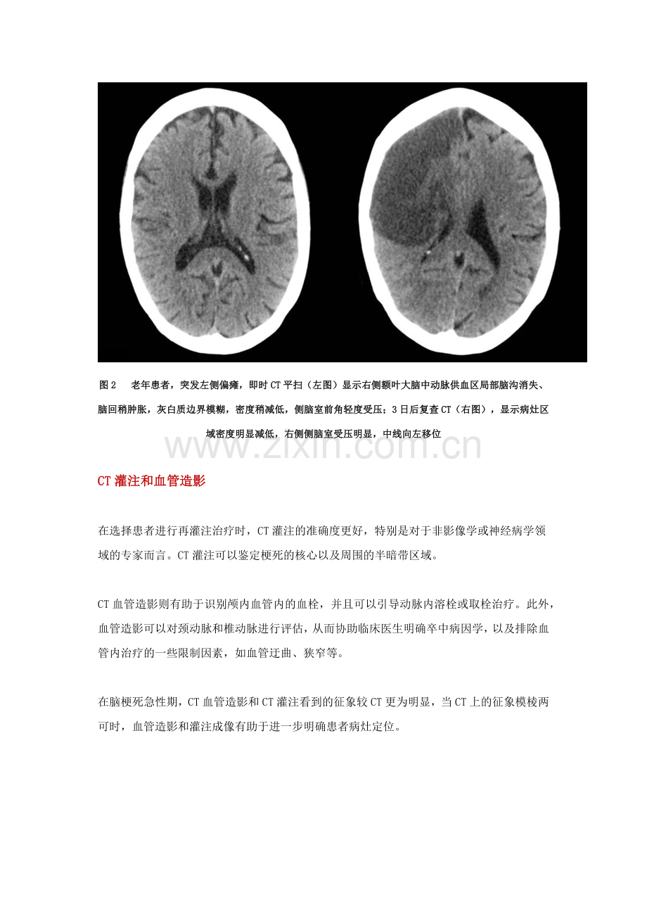 看图说话：缺血性脑卒中超急性期的影像学特点.doc_第3页