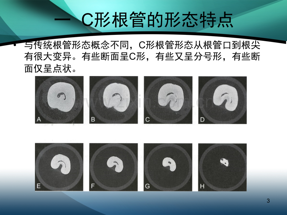 C形根管的分类及治疗(课堂PPT).ppt_第3页