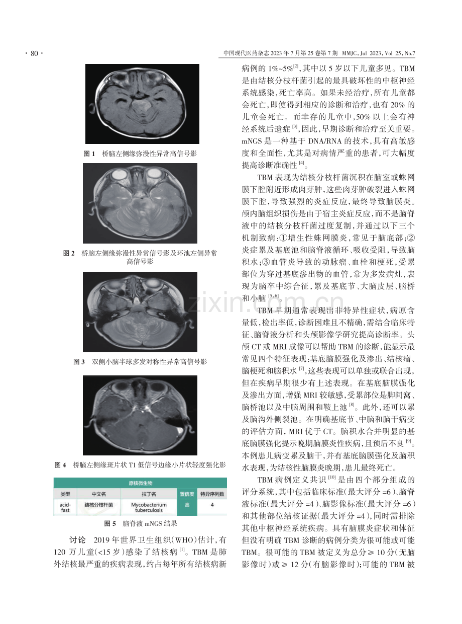 结核性脑膜炎1例临床特点与二代测序结果分析.pdf_第2页