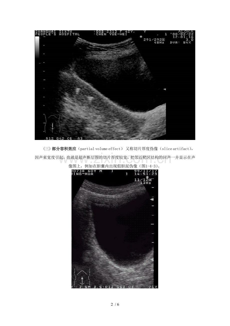 超声伪像.doc_第2页