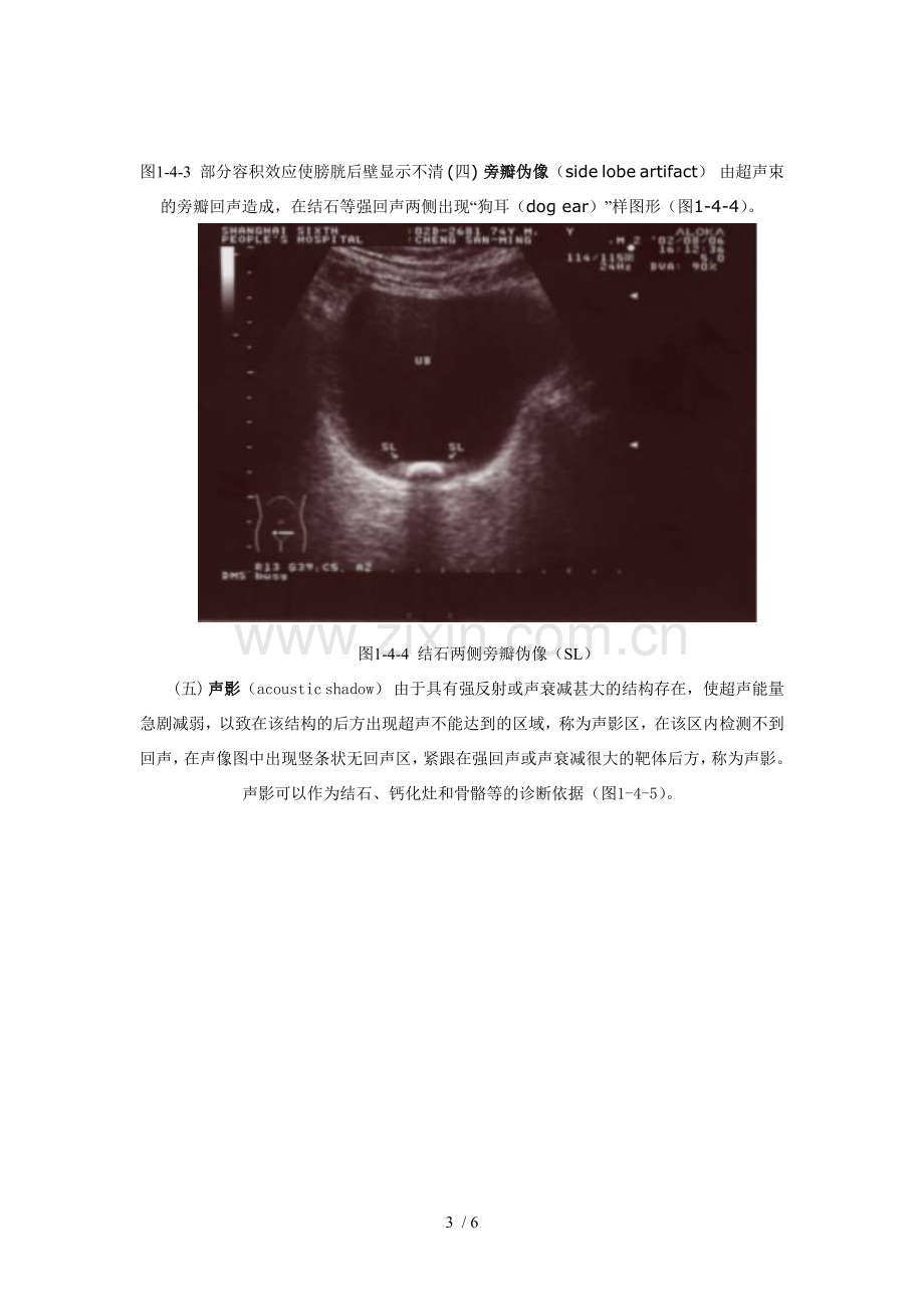 超声伪像.doc_第3页