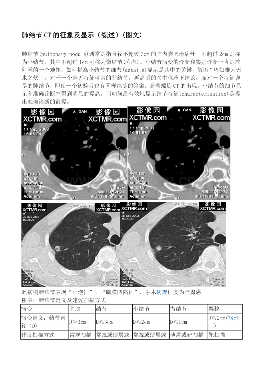 肺结节CT的征象及显示.doc_第1页