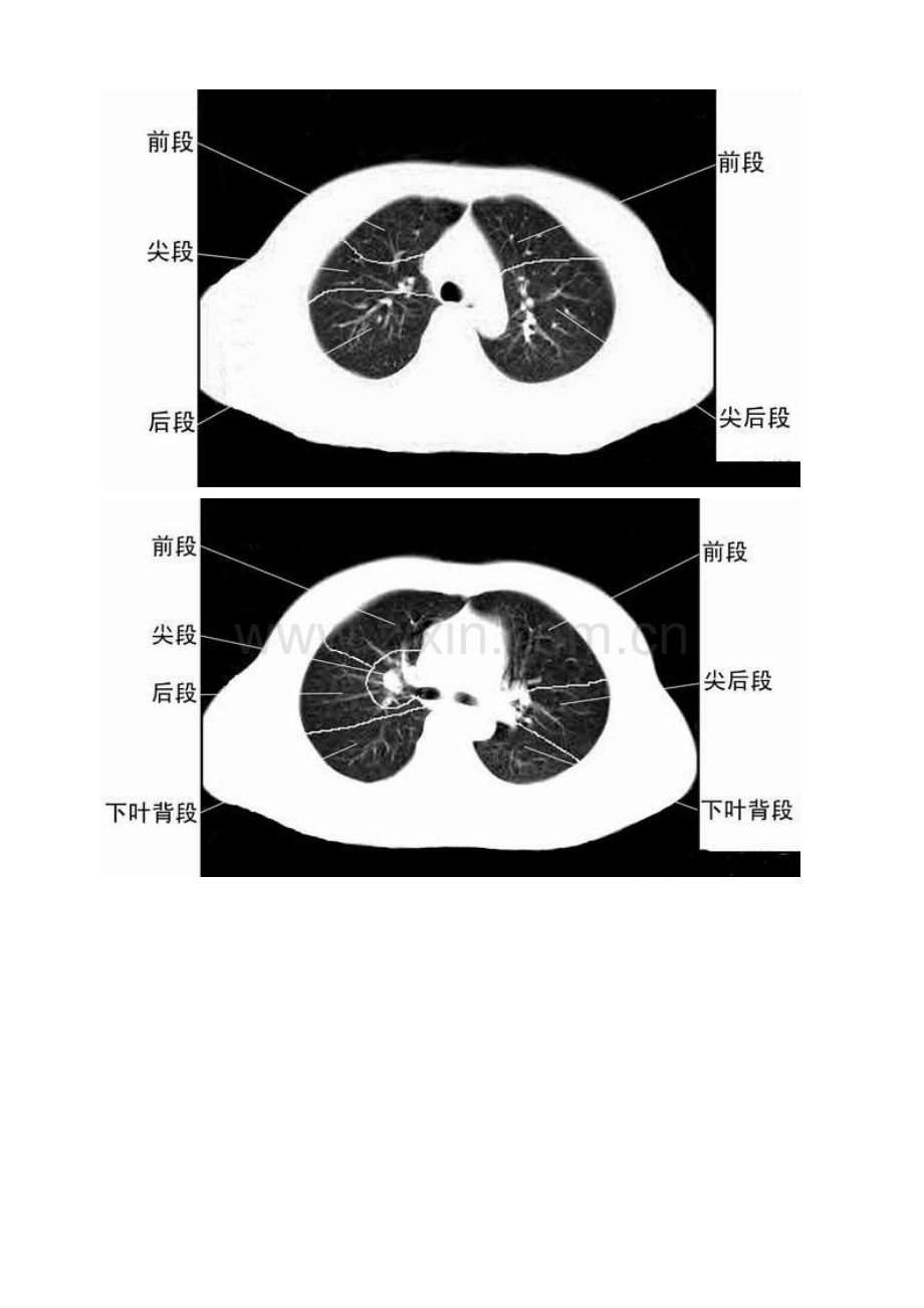 胸部CT肺段划分口诀.doc_第2页