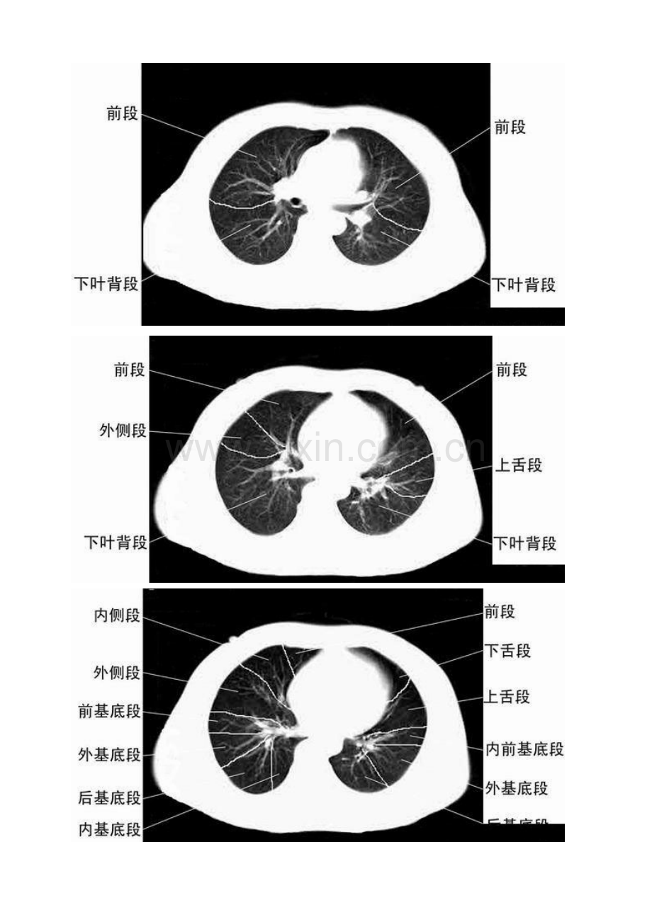 胸部CT肺段划分口诀.doc_第3页