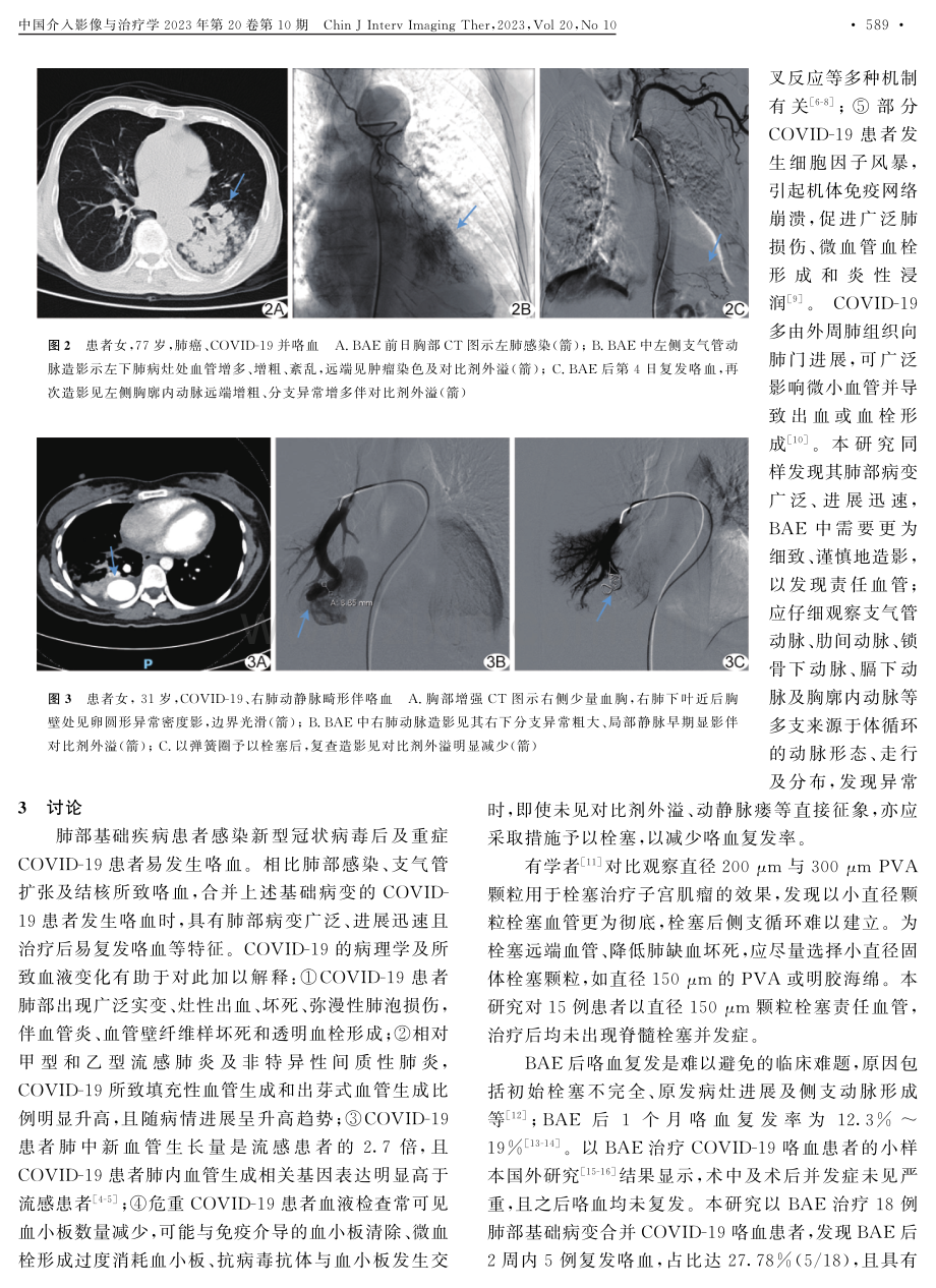 经导管支气管动脉栓塞术治疗肺部基础病变合并新型冠状病毒肺炎诱发咯血.pdf_第3页