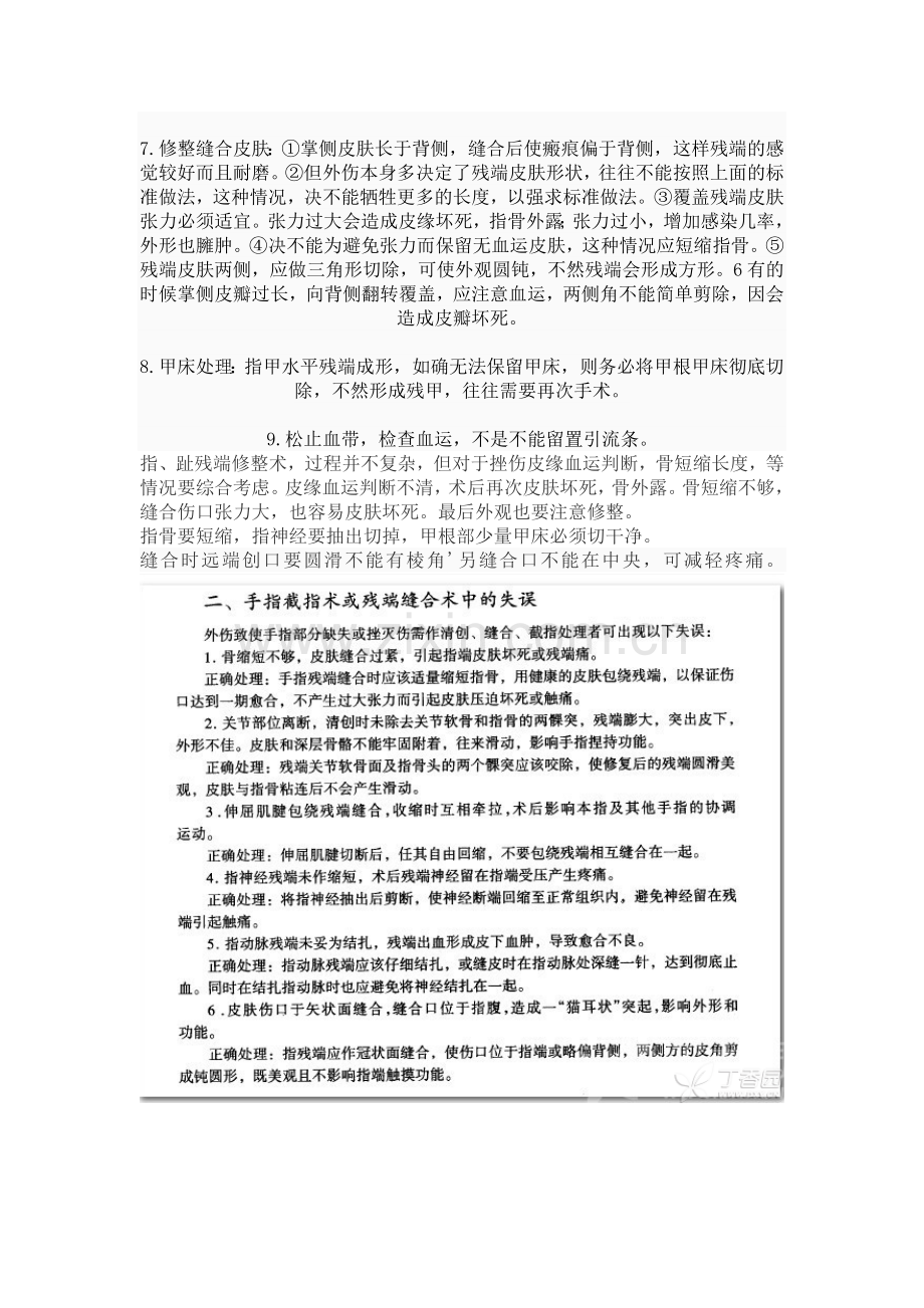 手指残端成形术.doc_第2页