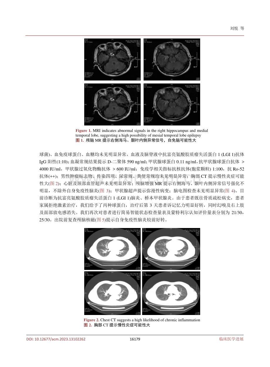 抗LGI1抗体相关脑炎一例病例报道并文献复习.pdf_第3页