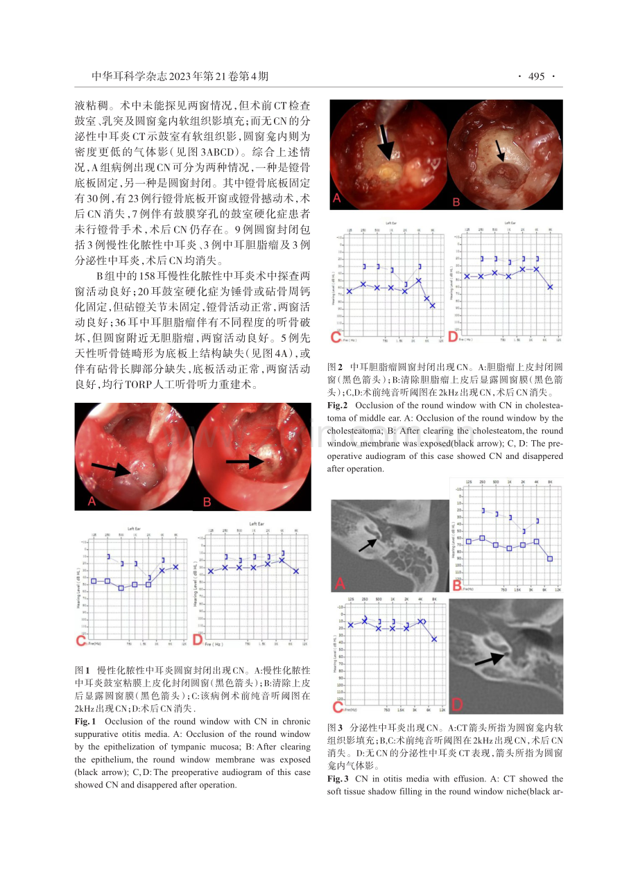 卡哈切迹在传导性耳聋相关疾病术前评估中的意义.pdf_第3页