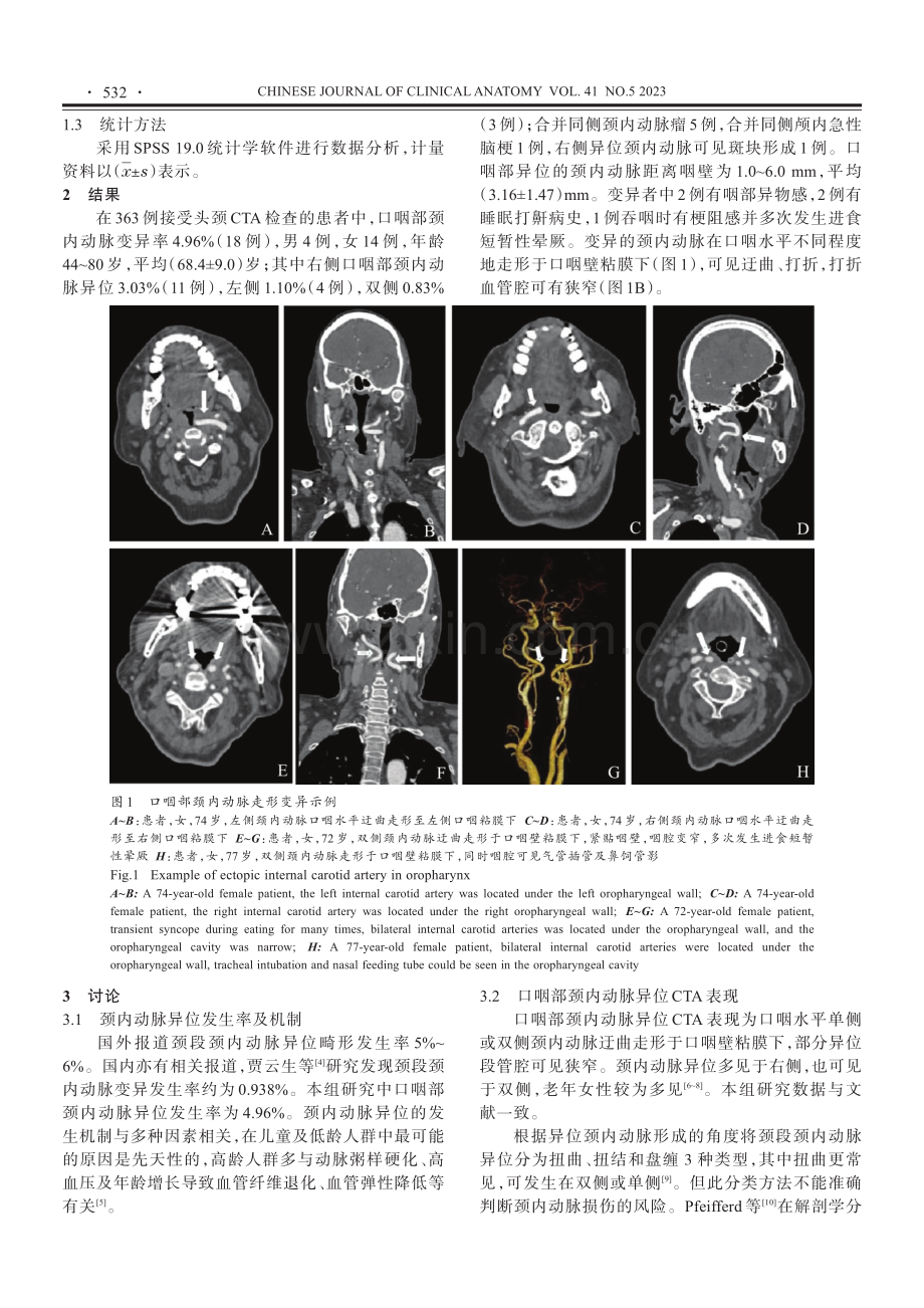 口咽部颈内动脉异位的CTA表现及临床意义.pdf_第2页