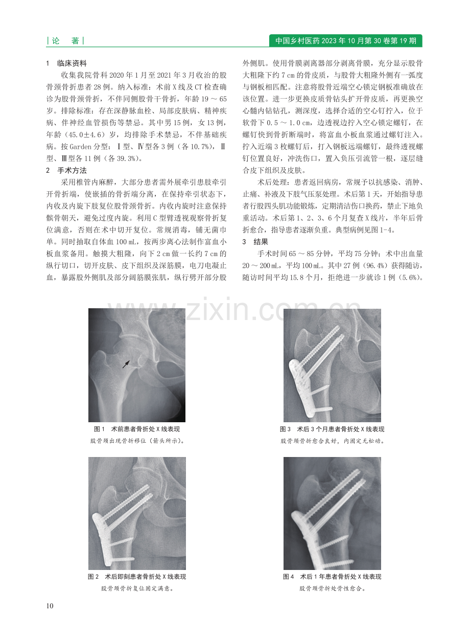 空心锁定钢板固定联合富血小板血浆局部注射治疗股骨颈骨折28例.pdf_第2页