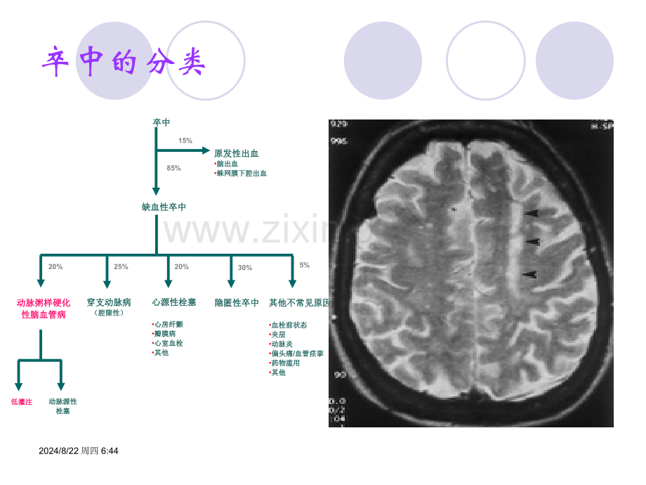 分水岭脑梗死和CT模板.pptx_第2页