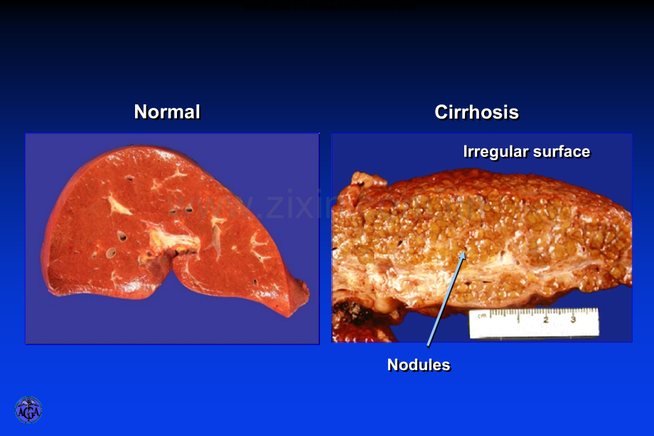 上海交通大学医学院内科学livercirrhosis.pptx_第3页