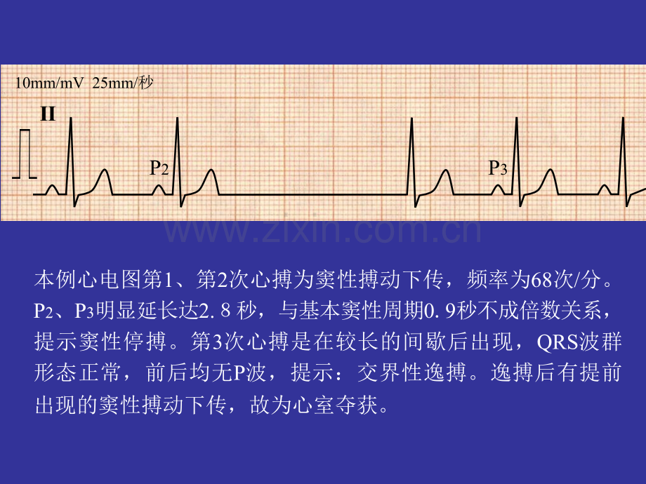 逸搏及逸搏心律.pptx_第3页