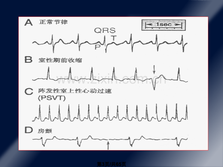22抗心律失常药.pptx_第3页